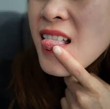 Image result for mouth ulcer on tongue)