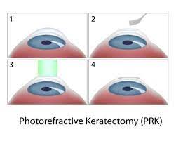 Lasik Alternatives Altoona Laser Vision Correction Brookville Pa Laurel