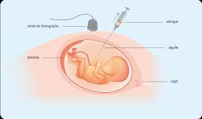 Il est l'organe d'échanges entre la mère et son fœtus, assurant sa. Examen Gynecologique Amniocentese Ameli Fr Assure