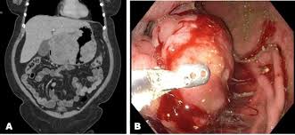 Image result for Leiomyosarcoma