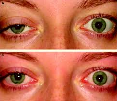 Miller Fisher Syndrome Syndrome Fisher Miller
