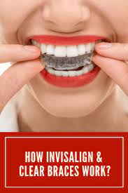 How Does Invisalign Braces Work Dubai Cosmetic Surgery Invisalign Discolored Teeth Dentistry