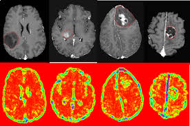 Gliomas for examples are primary brain tumors. Illustration Of Different Of Brain Tumor Types And The Corresponding Download Scientific Diagram