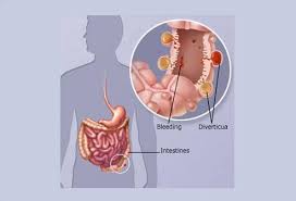 Diverticulitis Vs Ibs Differences Symptoms Causes