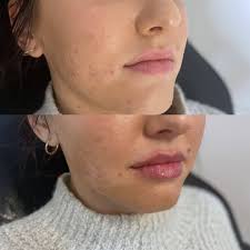 Profile for Nurse Injector Lisa