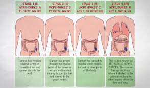 This is another potential sign of colon cancer. 10 Best Clinics For Colon Bowel Cancer Treatment In Morocco 2021 Prices
