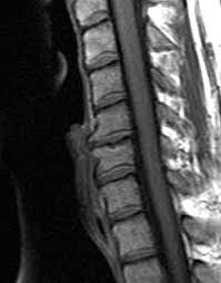 Degenerative Disc Disease Wikipedia