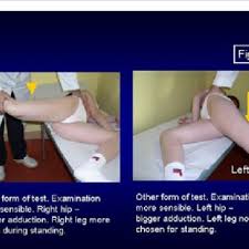 Image result for Crossed-Leg Test