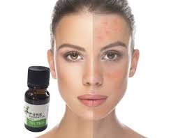 Tea tree oil and honey are even natural preservatives so you can keep this in a jar right in your add 5 drops of tea tree oil to 1/4 cup of plain yogurt and apply as a mask. How To Get Rid Of Acne Scars With Tea Tree Oil Tea Tree Oil For Acne Scars