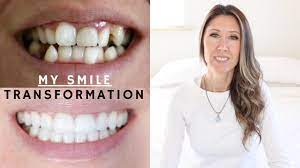 Pin On Invisalign