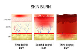 While these types of burns don't usually result in skin death, they can. Do You Know The 4 Degrees Of Burns First Aid Supplies Online