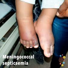 Explore pictures, causes, signs and symptoms of red spots, dots or patches on legs and feet. Meningococcal Septicaemia Skin Deep