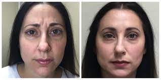 How long does botox last before you need another treatment? Botox Treatment For Wrinkles Stay Beautiful Medspa Woburn Ma