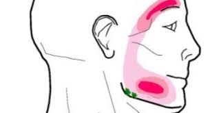 Pin On Trigger Points And Headache S