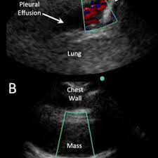 The largest pocket of fluid is present posteriorly at the right lung base, with associated atelectasis and minor consolidation. A Loculated Pleural Effusion A Complex Pleural Effusion Is Shown With Download Scientific Diagram