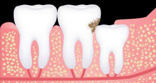 The cost of extracting a single wisdom tooth varies, depending on the complexity of wisdom tooth extraction treatment. Wisdom Tooth Removal Best Laser Dental Clinic Implant Centre