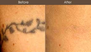 We are driven by our results! Tattoo Removal Nyc Birthmark Removal Melasma Manhattan