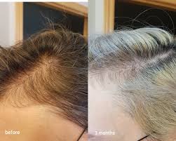 Formulated with ingredients clinically shown. Three Month Results The Ordinary Multi Peptide Serum For Hair Density Raiyne On Beauty