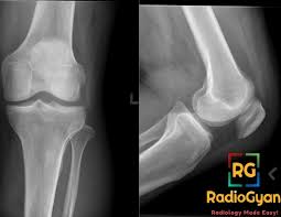 Image result for Prepatellar Bursitis