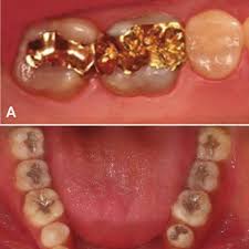 Maybe you would like to learn more about one of these? Dental Fillings A Gold B Amalgam Endocrine System And Consequently Download Scientific Diagram