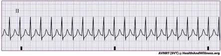 This page is about the various possible meanings of the acronym, abbreviation, shorthand or slang term: Vagal Maneuvers How To Stop Your Patient S Svt Health And Willness