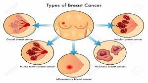 Invasive breast cancer means the cancer cells have moved beyond the lining of the milk ducts and invaded the surrounding breast tissue. Know More About Types Of Breast Cancer Peeker Health