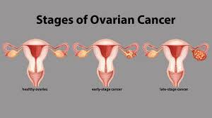 Understanding The Progression Of Esophageal Cancer Everyday Health