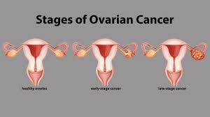 Ovarian epithelial cancer is the most common type of ovarian cancer. What Are The Stages Of Ovarian Cancer Everyday Health