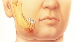 Menghilangkan rasa sakit dengan obat sakit gigi memang membuat orang merasa kurang nyaman. Tips Dan Petua Hilangkan Sakit Gigi Tanpa Guna Ubat 6 Petua