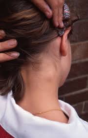 Lymph nodes and staging cancer. Cervical Lymphadenopathy Wikipedia