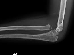Image result for Radial Head Dislocation