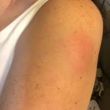 Tdap Injection Site Hard Very Painful Lump Hot To The Touch And Itchy About 3 4 In Wide Is This Normal For Nearly 3 Days Later Glow Community