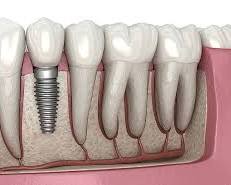 dental implant prosthesis