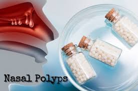 Nasal polyps (pearly gray lumps developing on the mucus membrane linings) can be visible (hang out of the nostrils) or not visible in that they develop in the deep recesses of the nasal. Homeopathic Remedies Medicines Treatment For Nasal Polyps