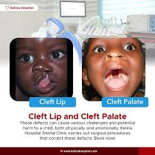 Image result for Cleft Lip