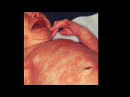 The virus becomes active again at unpredictable times, causing shedding. Case 317 Neonatal Rashes Erythema Toxicum Neonatorum Hsv Herpes Simplex Varicella Urticaria Youtube