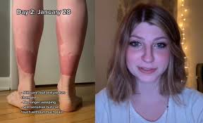 Mulher sofre com condição rara que faz sua pele descamar rapidamente