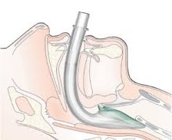 I Gel Supraglottic Airway Protocopedia