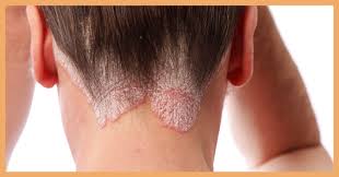 Ringworm can lead to significant hair loss in the affected individuals and up to 50% hair loss in affected children. Can Scalp Psoriasis Cause Hair Loss Delfina Skin
