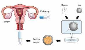Schließlich war ich dieses mal 4 mal beim ultraschall und dann wurden die. Embryo Transfer Technique And Process Ett In Ivf Or Icsi Indira Ivf