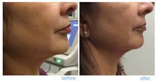 Image result for how long does it take for mesotherapy to heal after first treatment