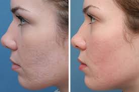 3 cách trị sẹo thâm bằng công nghệ mới nhất hiện nay -... 