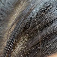 According to the nhs, if you spot small bugs or tiny white eggs in the crevices and joints of your mattress and furniture, you should inspect the rest of your stuff for further signs of an infestation. Getting Rid Of Bugs In Hair Thriftyfun