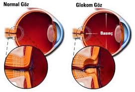 Glokom Goz Tansiyonu