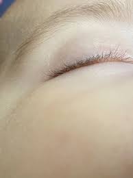 This is going to be a test of will and patience!. White Hair Growing Out Of Baby S Eyelid Babycenter