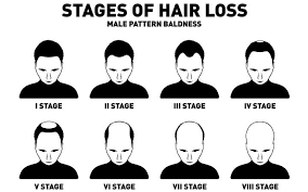 Causes of hair loss in men. The Link Between Testosterone And Hair Loss In Men And Women Skinkraft