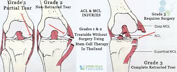 In general, these injuries are managed with nonsurgical treatment. Stem Cell Treatment Repair Cartilage Ligament Tendon Injuries