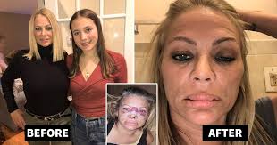 She's the content strategist of. Plastic Surgery Gone Wrong As Mom Left With Lumpy Lips And Misshaped Nose