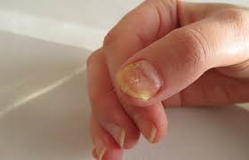 Using a natural remedy makes it much safer to treat a fungal infection fast. Living With Nail Fungus Buy Funginix