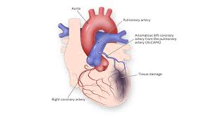 Veins bring blood to the heart to pump back out again on arteries. Anomalous Left Coronary Artery From The Pulmonary Artery Children S Hospital Of Philadelphia